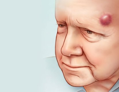 Merkel Hücreli Karsinom Tedavisinde Retifanlimab İmmünoterapisi FDA Onayı Aldı