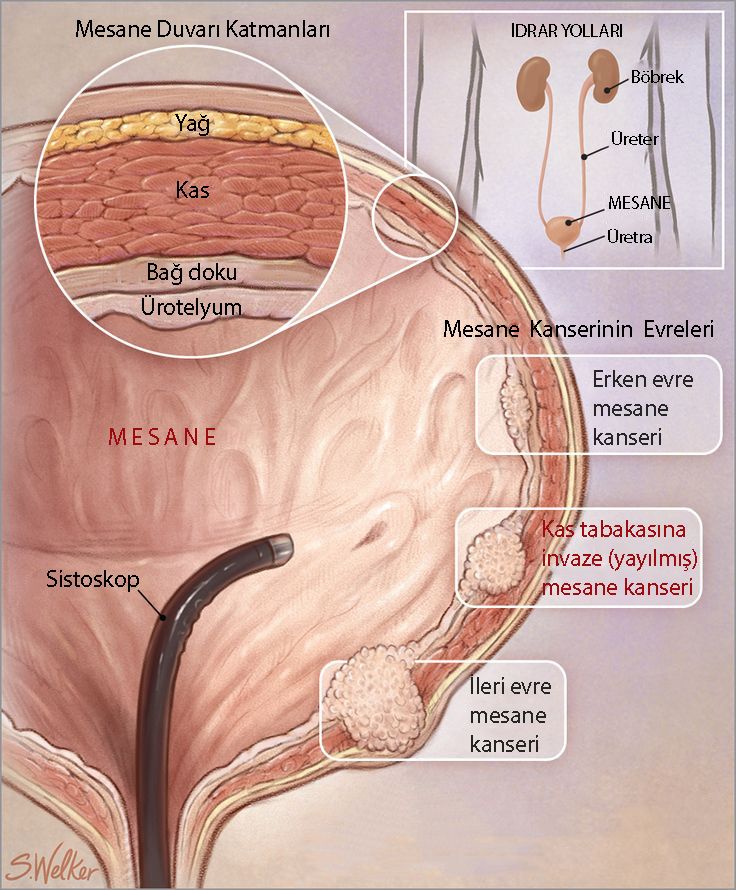 stadiile cancerului vezical și invazia musculară