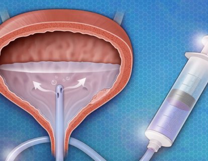 Mesane Kanserinde BCG Tedavisi Nedir?