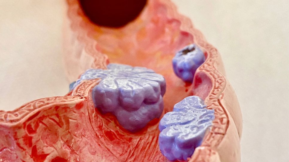 Lonsurf și bevacizumab au primit aprobarea FDA pentru linia a 3-a de tratament a cancerului colorectal metastatic