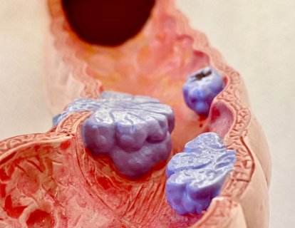 Metastatik Kolorektal Kanser 3. Basamak Tedavisinde Lonsurf ve Bevasizumab FDA Onayı Aldı