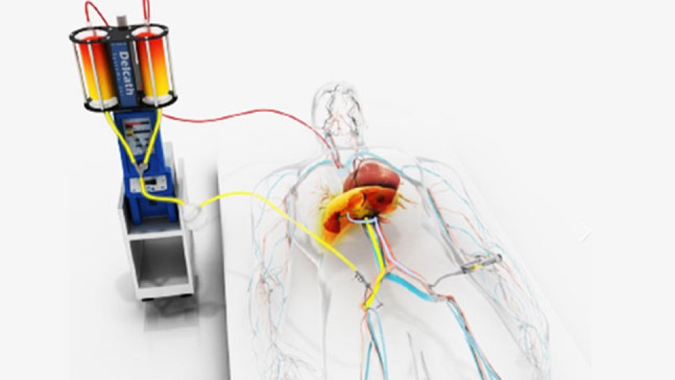 Melphalan Liver-Directed Therapy Receives FDA Approval for Metastatic Uveal Melanoma