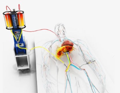 Metastatik Uveal Melanom İçin Melphalan Hepatik Tedavisini FDA Onayı Aldı