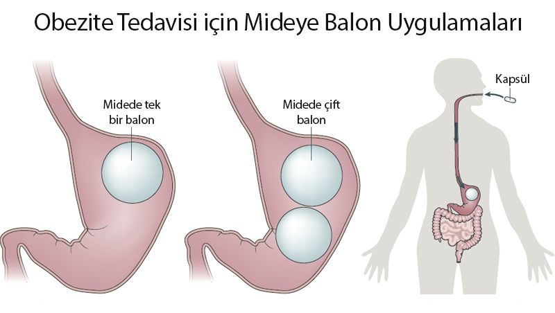 mide balonlari sisirilebilir tekli coklu balon yerlestirme 737120