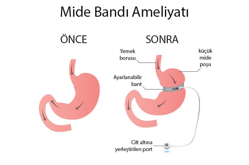 mide bandi cerrahisi once sonra gastrik band 152091