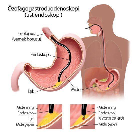 Magenbiopsie, Ösophagogastroduodenoskopie: Ablauf einer oberen Endoskopie