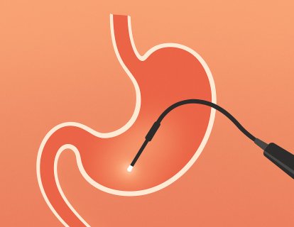 Mide Kanserini Önlemek Mümkün mü? Kimler Yüksek Risklidir ve Neler Yapmalı?