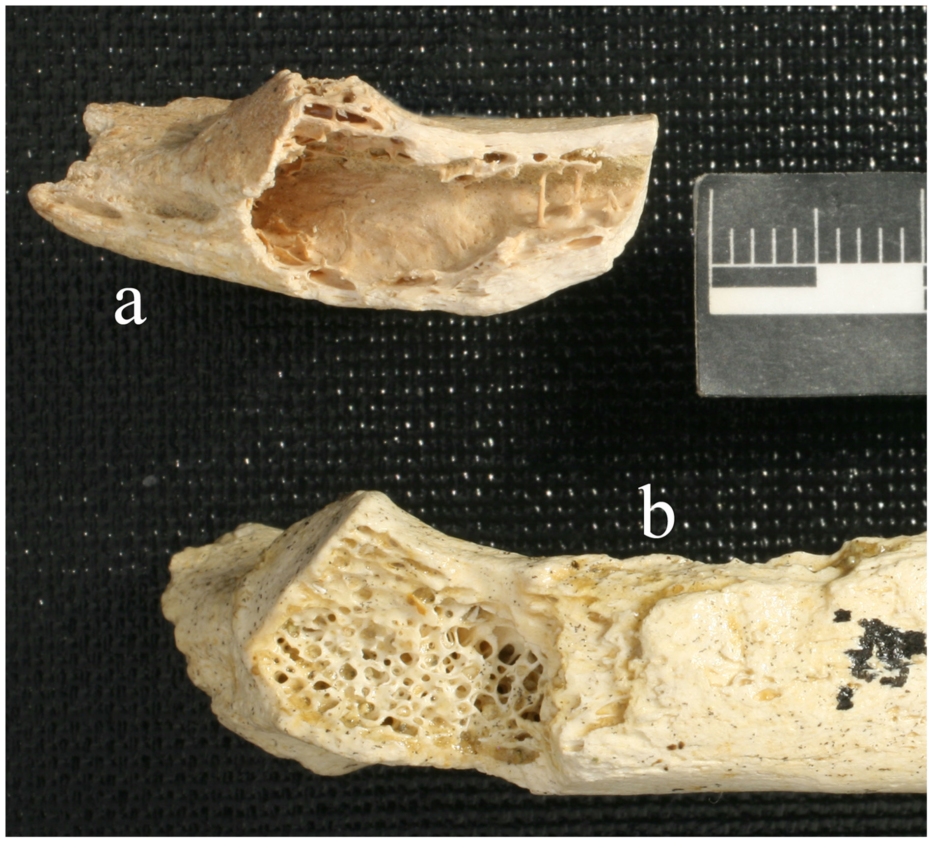 Neandertaler fibröse Dysplasie PLoS ONE