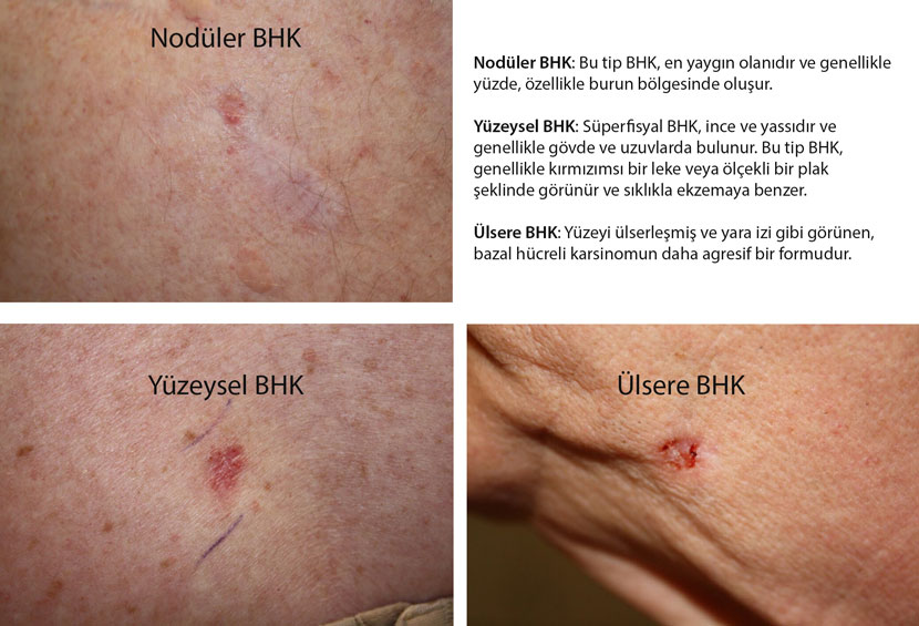 noduler yuzeysel ve ulsere bazal hucreli karsinom fotograflari 103719