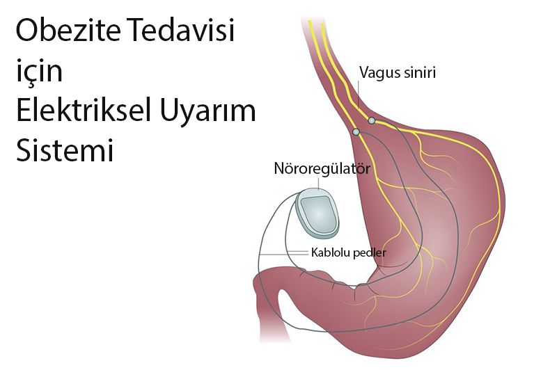 obezite icin elektriksel uyari sistemi vagal sinir blokaji 685633