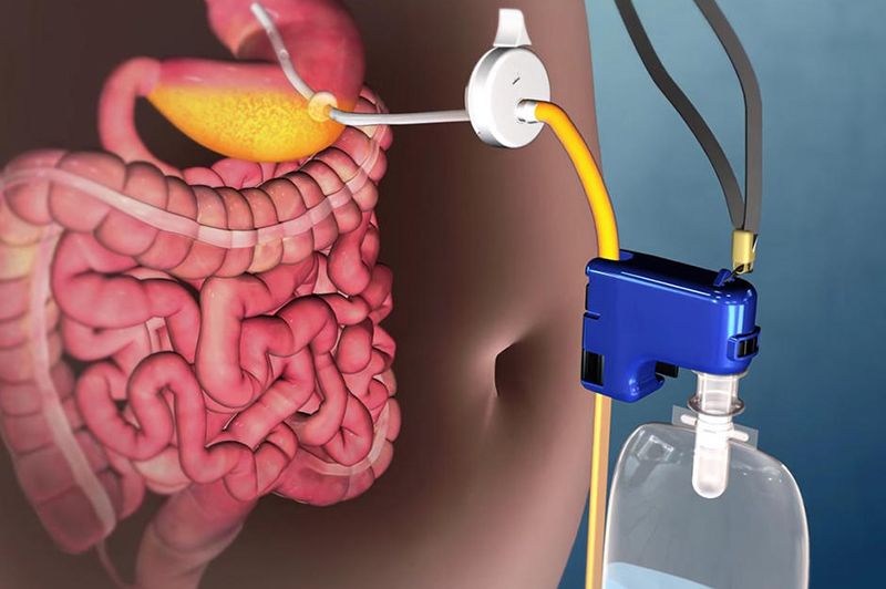 obezite tedavisi mide bosaltim sistemi aspire assist 270236
