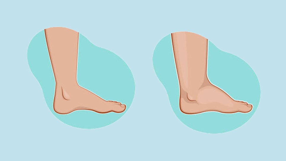 What Methods Help Reduce Edema Quickly?
