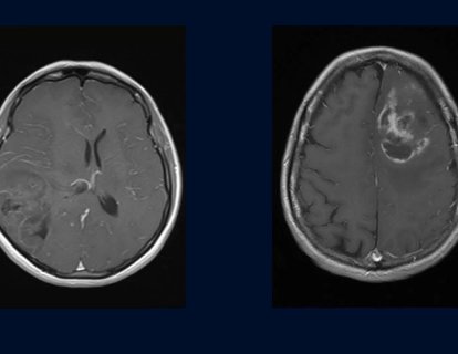 Oligodendroglioma Nedir? Belirtileri ve Tedavisi