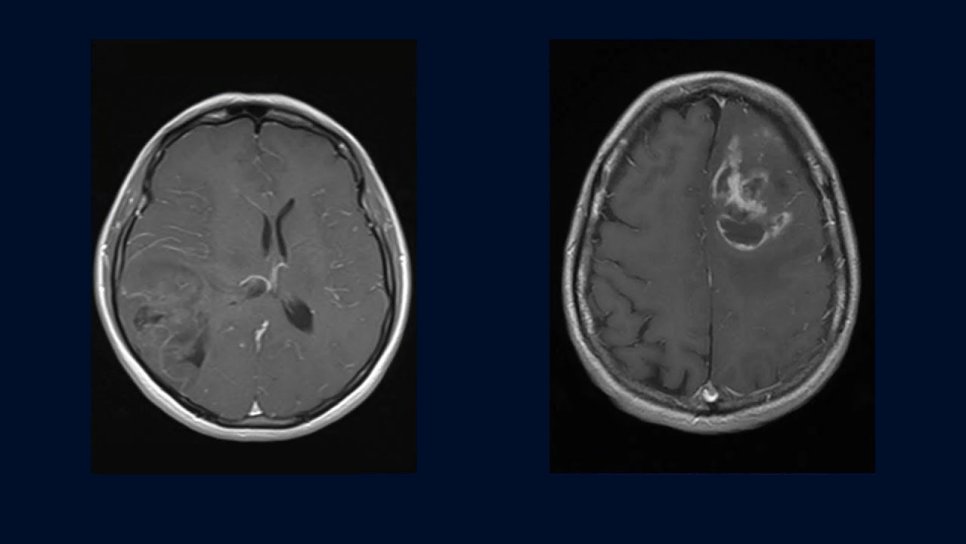 Oligodendroglioma Nedir? Belirtileri ve Tedavisi