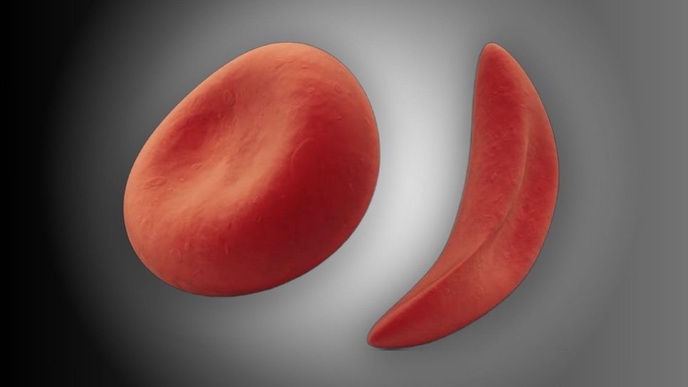 Cauza anemiei falciforme, 1949 – prima tulburare genetică identificată