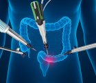 Is Robotic Surgery Superior in Rectal Cancer? Evaluating the Evidence from the REAL Trial