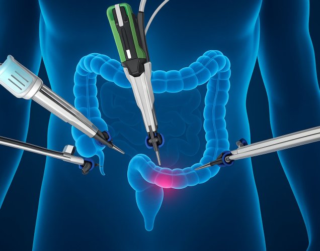 Orta ve Alt Rektum Kanserinde Robotik Cerrahi Üstünlüğü – Çin Çalışması Yeterli mi?