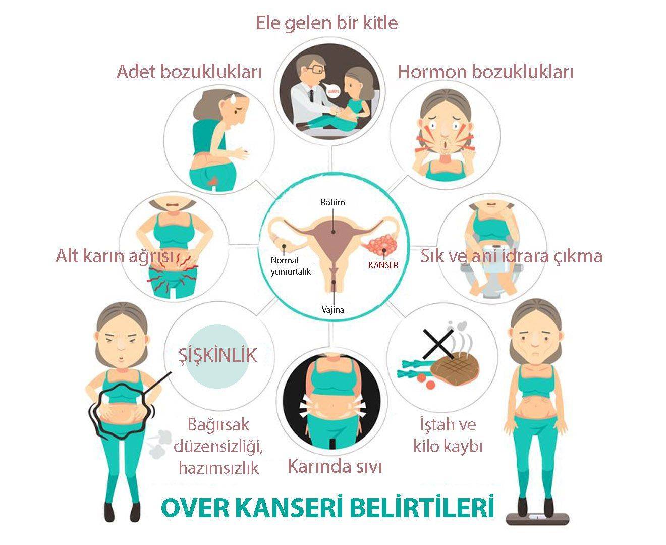 Over — yumurtalıq xərçənginin əlamətləri və tapıntıları hansılardır?