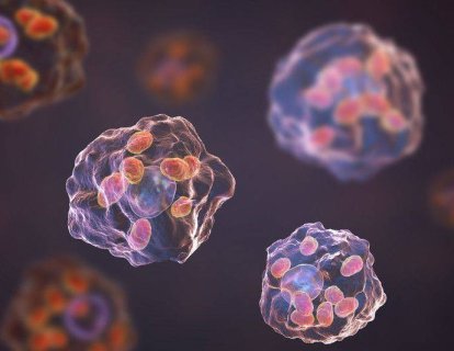 Over (Yumurtalık) Kanseri Metastazının Mekanizması Çözüldü – Sırada Engel Olmak Var