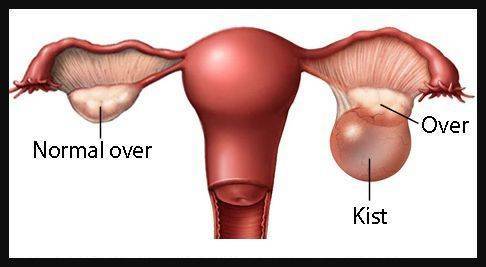 over yumurtalik kisti nedir cesitleri 374631