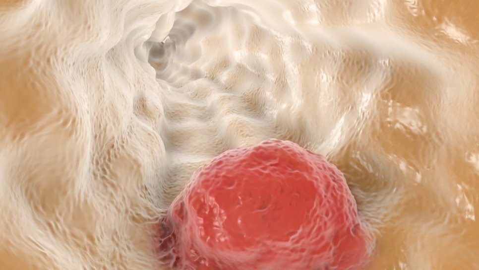 Immunotherapy Nivolumab Receives FDA Approval for Second-Line Treatment of Esophageal Cancer