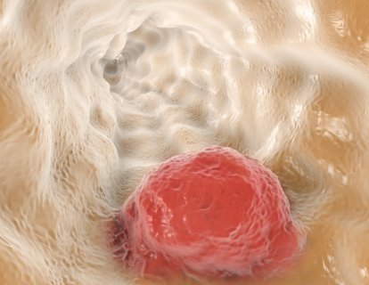 Özofagus (yemek borusu) kanseri ikinci basamak tedavisinde immünoterapi nivolumab FDA onayı aldı