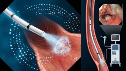 Özofagus Kanserinde Sıvı Nitrojen Kriyoterapisi: FDA Durumu ve Güncel Kanıtlar