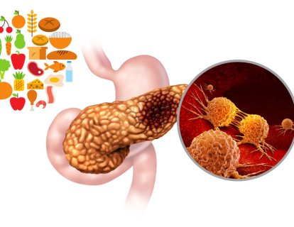 Pankreas Kanserinde Beslenme Desteği ve Pankreatik Enzim Yerine Koyma Uygulamasının Önemi