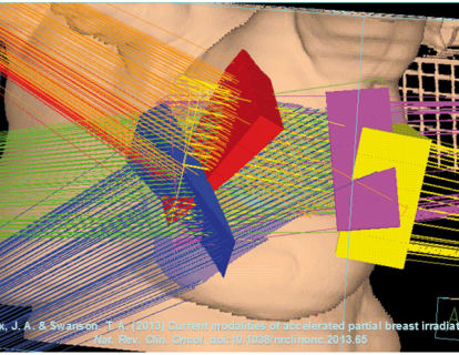 Ameliyat Sonrası Koruyucu Amaçla Uygulanan Kısmi Meme Radyoterapisi ile Tüm Meme Radyoterapisinin Karşılaştırılması