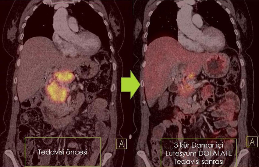 pankreas noroendokrin kanserini iyi diferansiye tip en iyi degerlendiren yontem galyum pet ct dotat