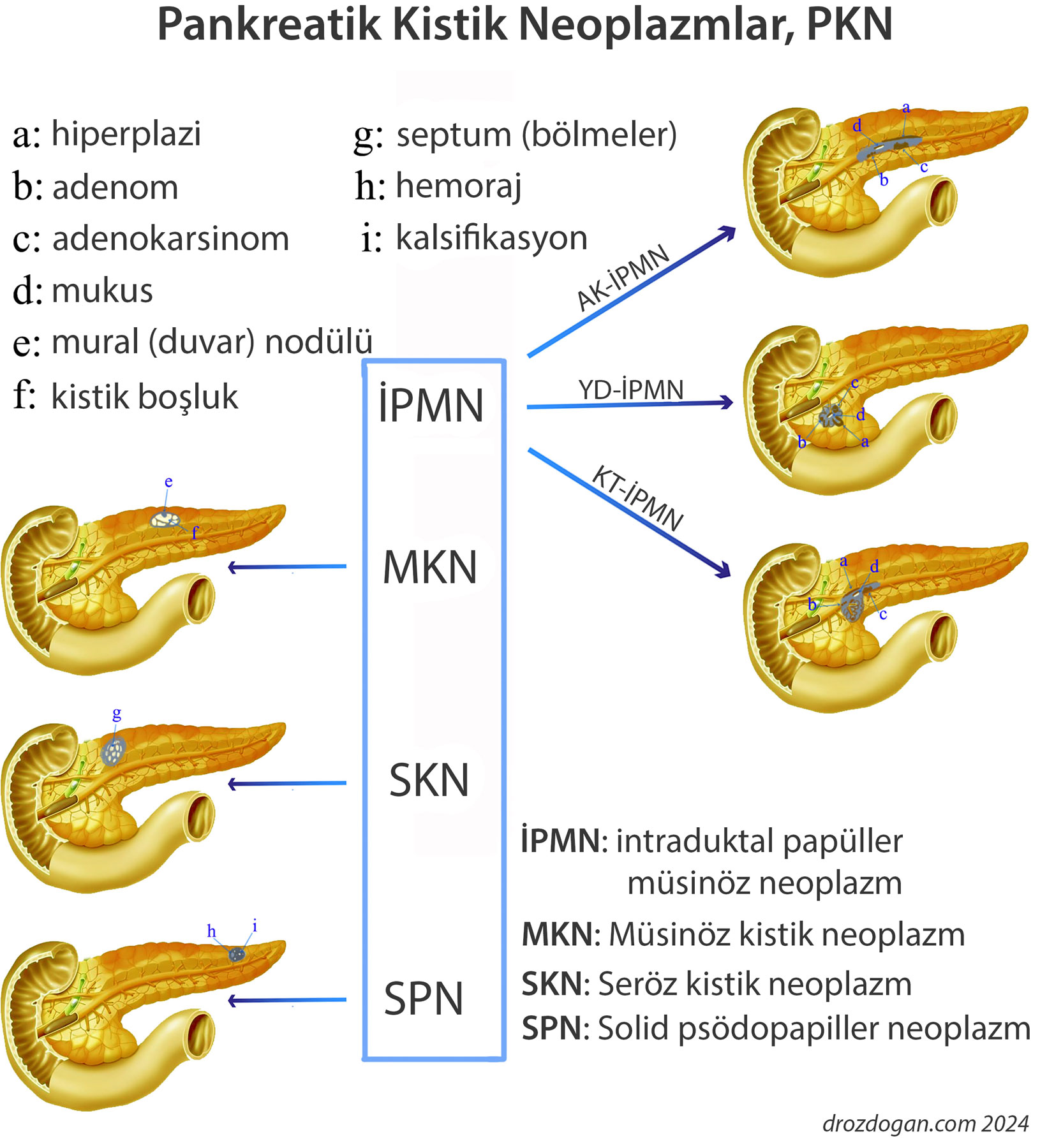 Zystische Veränderungen der Bauchspeicheldrüse: Neoplasien und intraduktale papillär-muzinöse Neoplasien