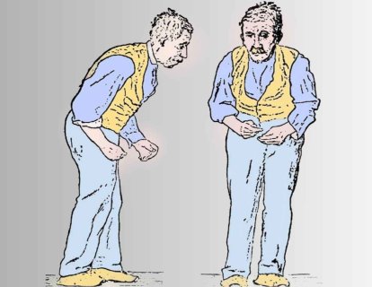 Parkinson Hastalığı için Levodopa 1957 – Mucizevi Tedavi