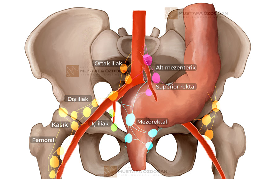 pelvik bolge rektum kanseri nodal tutulum lenf nodlari anatomisi 103196