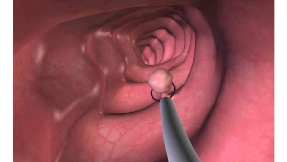 Does Polyp Size Affect Cancer Risk? A Colon Polyp Size Chart