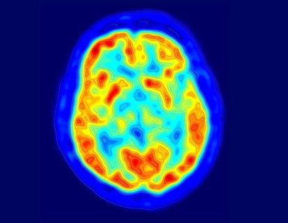 Pozitron Emisyon Tomografisi (PET) 1973 – Üç Boyutlu Tıbbi Görüntüleme
