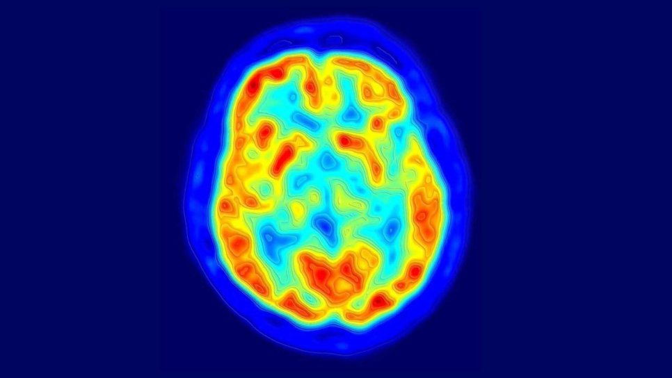 Positron Emission Tomography (PET) 1973 – Three-Dimensional Medical Imaging