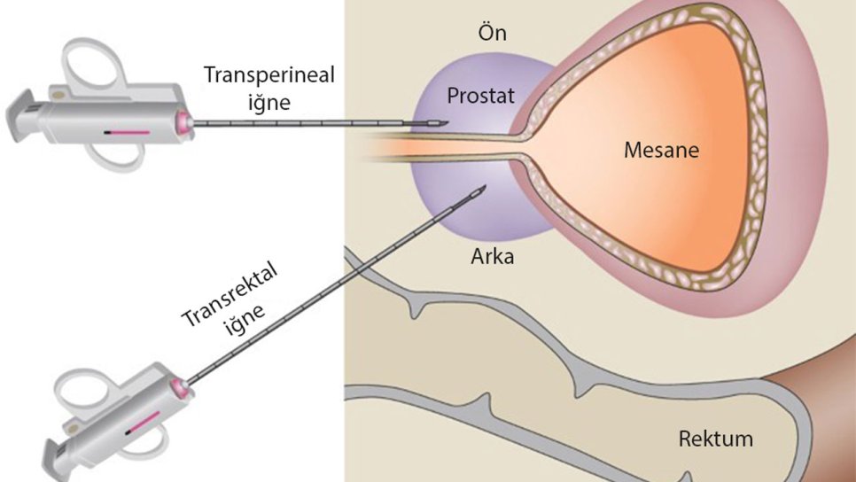 Prostat biopsiyasında ən yaxşı üsul hansıdır?