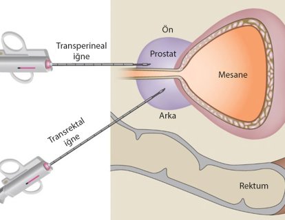 Prostat Biyopsisinde En İyi Yöntem Hangisidir?