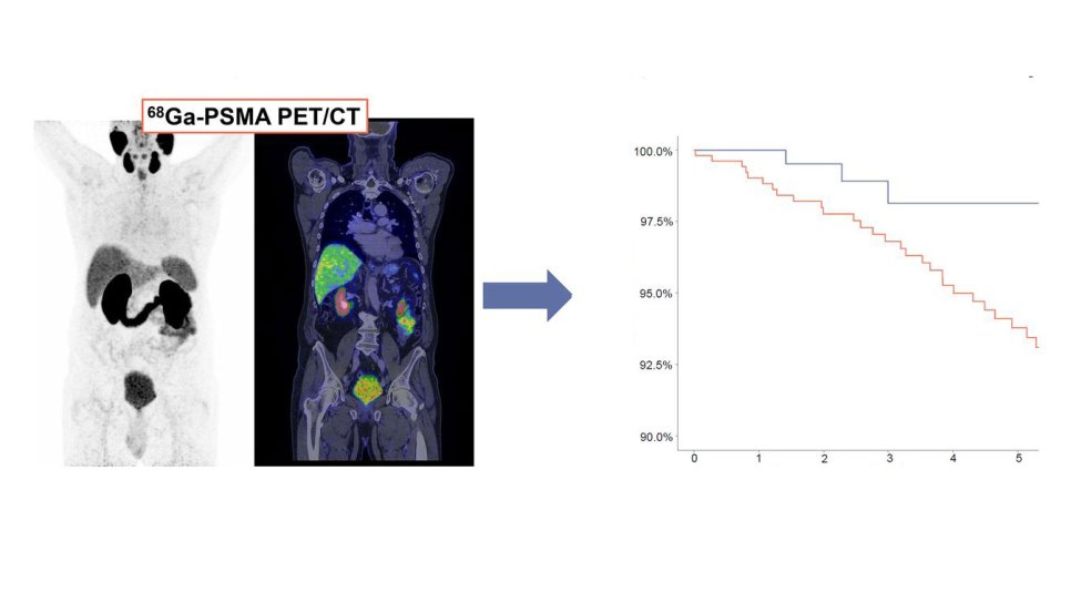 نقش نجاتبخش PSMA PET/CT در درمان عود بیوشیمیایی سرطان پروستات