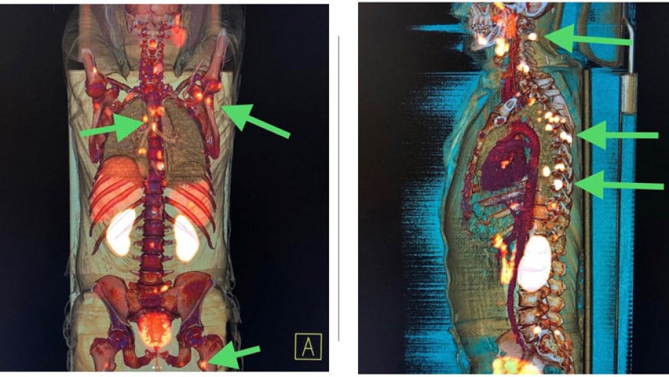 با PSMA PET-CT ممکن است مردان بالای 80 سال به بیوپسی پروستات نیاز نداشته باشند