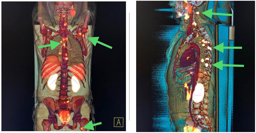 prostat kanserinde kemik metastazlarini gostermede psma pet ct 359329