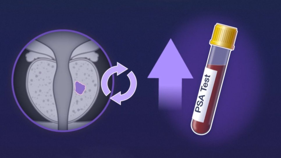 Prostat xərçənginin gizli təhlükəsi: biokimyəvi residiv nədir?