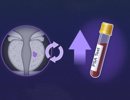 Prostat Kanserinin Gizli Tehlikesi: Biyokimyasal Nüks Nedir?