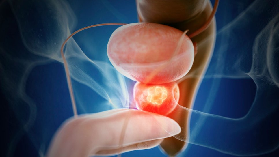 Die Stärke der aktiven Überwachung bei frühem Prostatakrebs