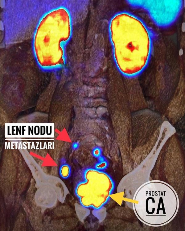 psma pet ct ornegi lenf nodu metastazlari prof dr akin yildiz 708301