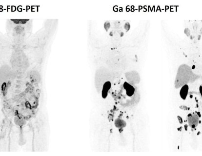 PSMA-PET Nedir? Prostat Kanseri Yayılımı için Neden En İyi Görüntüleme Yöntemidir?