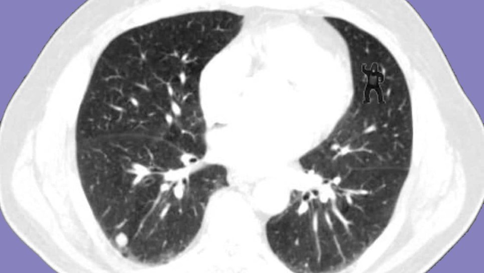 Radiologists or AI? A Gorilla Too Big to Ignore