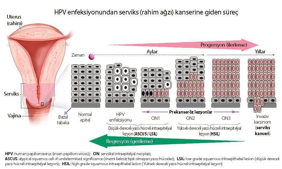 سرطان دهانهٔ رحم یا سرویکس چگونه ایجاد میشود؛ ضایعهٔ پیشسرطانی CIN، عفونت HPV، ASCUS، HSIL و LSIL