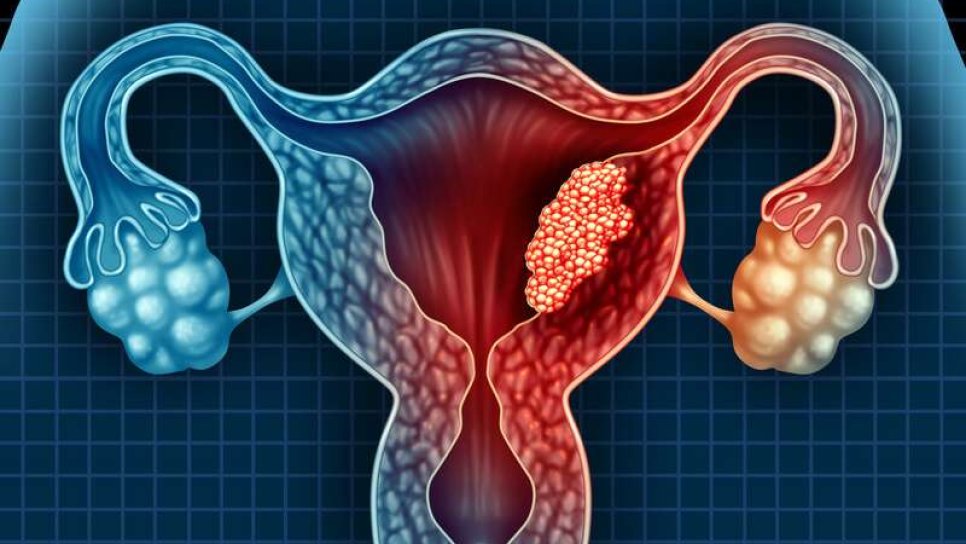 Rahim kanseri tedavisinde bir ilk: immünoterapi ve akıllı ilaç kombinasyonu FDA onayı aldı