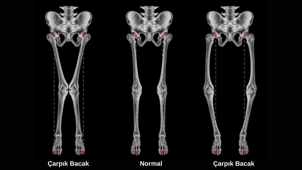 Rickets 1922 – Nutritional Deficiency and Bowed Legs